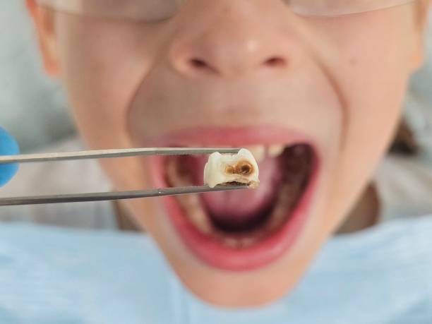 Best Emergency Dental Extractions in Spry, PA